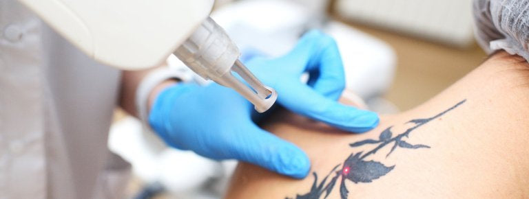 Laser Tattoo Removal