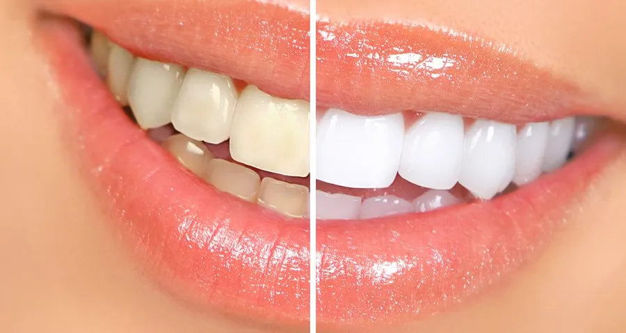 40 minutes cosmetic teeth whitening treatment